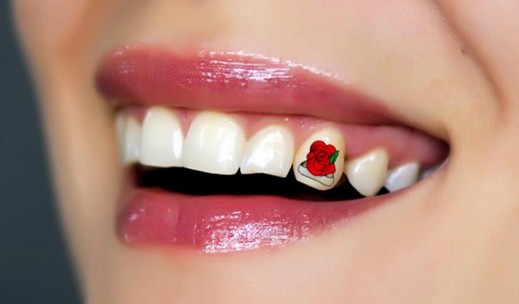 Что такое бабочка в стоматологии для зубов фото